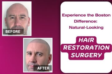 Experience-the-Boston-Difference-Natural-Looking-Hair-Restoration-Surgery