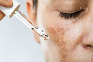 Why is Melasma so difficult to treat in Islamabad?