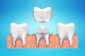 Crown Lengthening