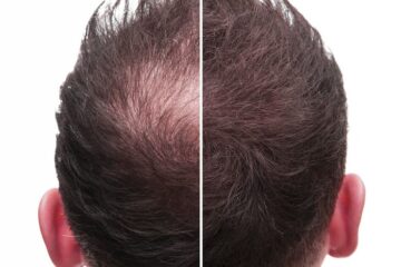 hair loss clinic in juhu