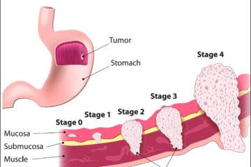 Gastric Cancer Drug