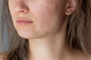 Acne Treatment in Greater Kailash