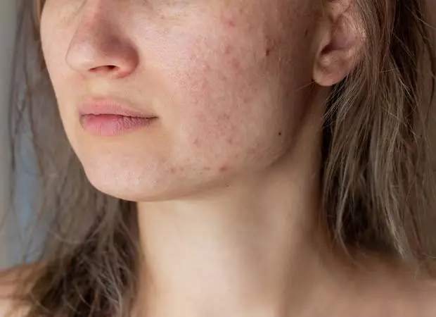 Acne Treatment in Greater Kailash