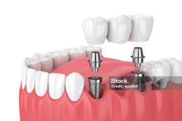 dental bridge