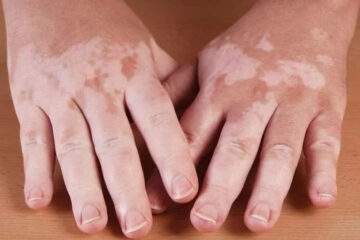 Best Vitiligo Treatment in Delhi