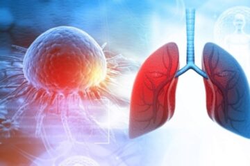 Lung Cancer Treatment Cost in India