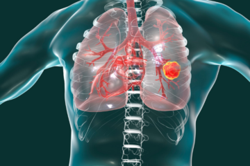 Non-Small Cell Lung Cancer