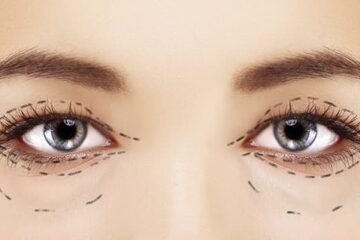 eyelid surgery san diego